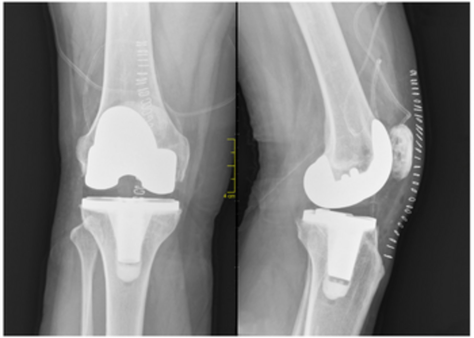Bilateral Total Knee Replacement