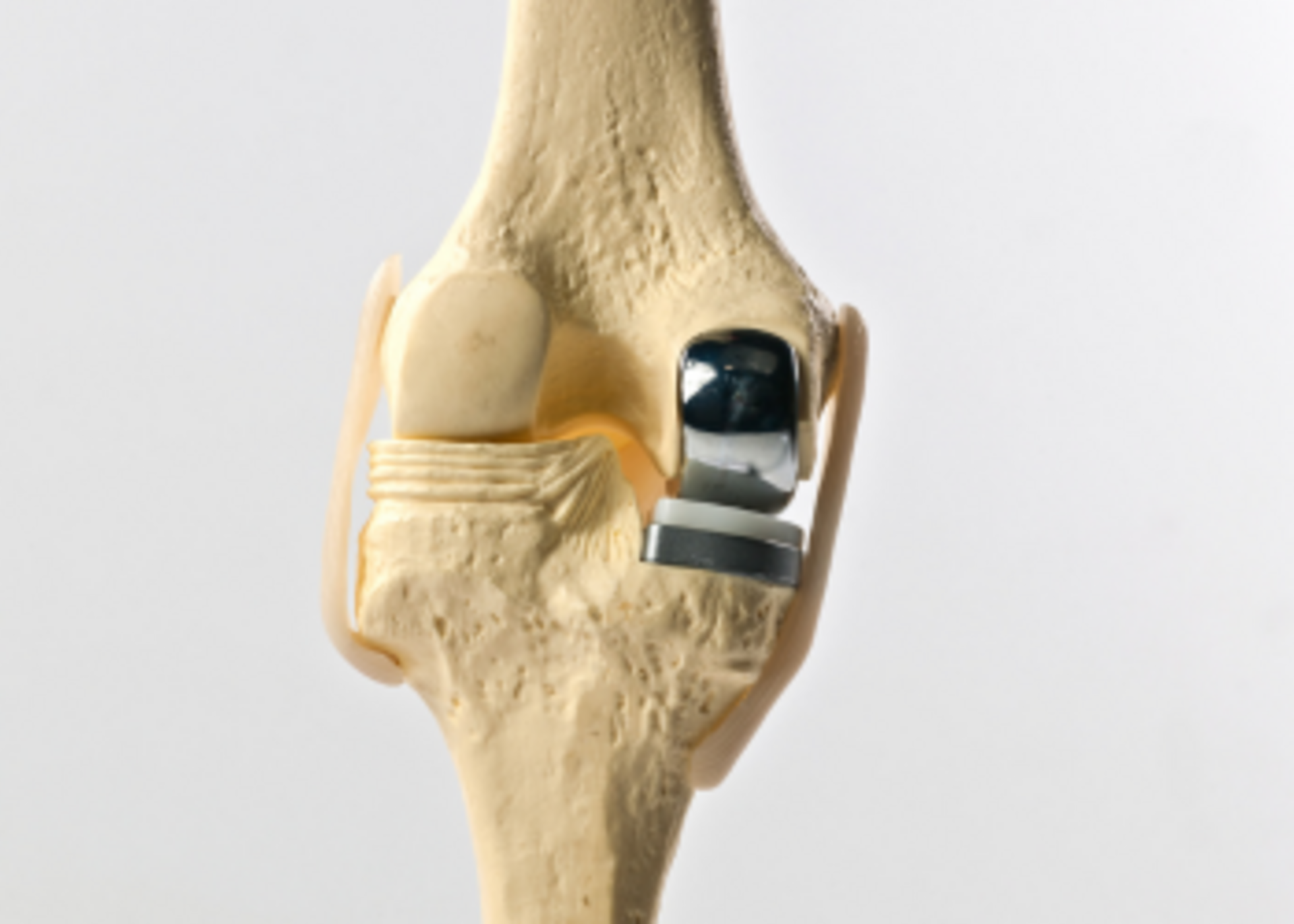 Unicompartmental / Total Knee Replacement