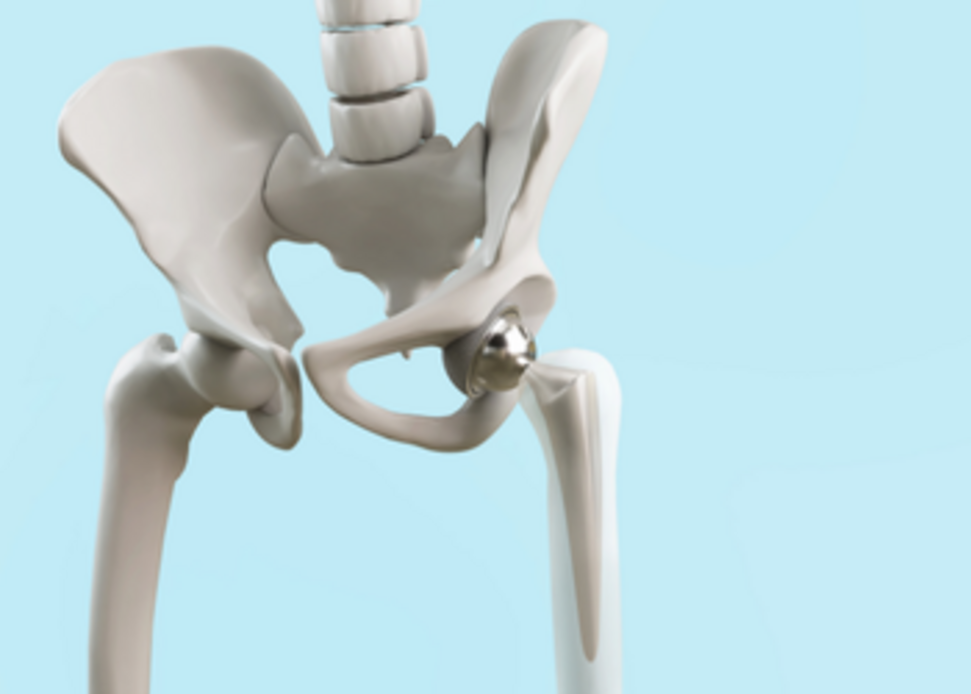 Hip Replacement Surgery